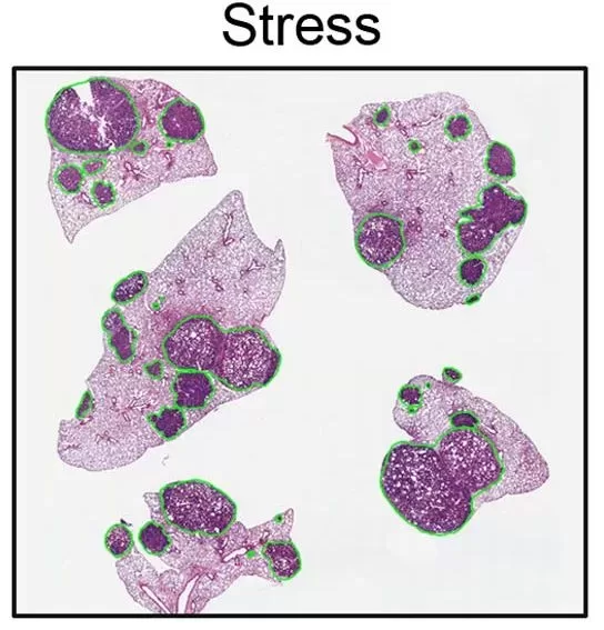 stres metastaza jpg webp