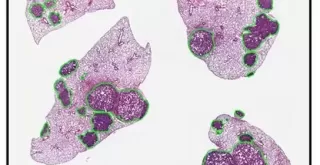 stres metastaza jpg webp